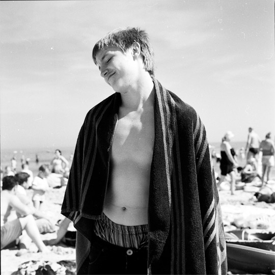 sunburn